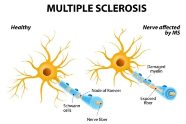 Multiple Sclerosis Treatment in Thane - Dr. Deepak Aiwale