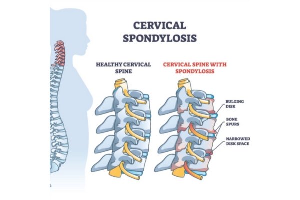 Cervical Spondylosis Treatment by Top Neurologist in Thane