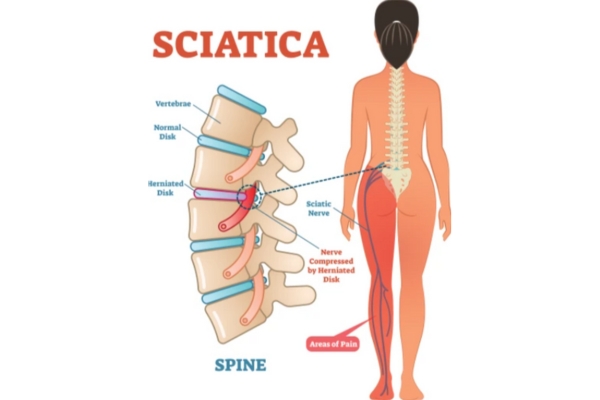 Sciatica Relief with Dr. Deepak Aiwale in Thane