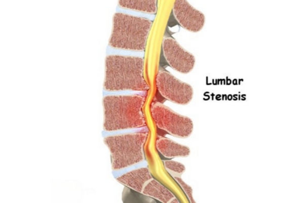 Comprehensive Care for Lumbar Canal Stenosis by Dr. Deepak Aiwale