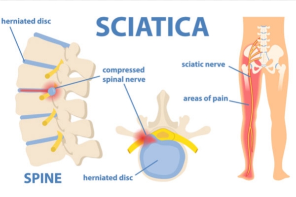 Sciatica Specialist in Thane – Dr. Deepak Aiwale