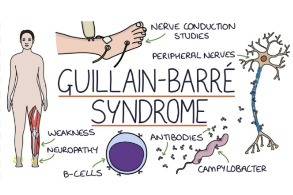 GBS (Guillain-Barré Syndrome) Specialist in Thane