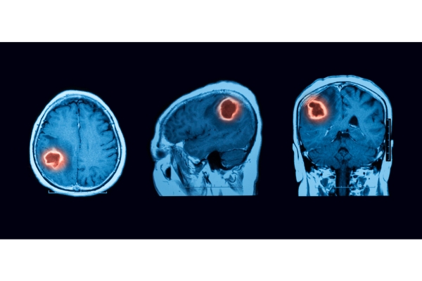 Brain Tumor Specialist in Thane