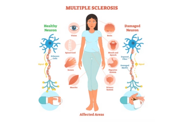 Dr. Deepak Aiwale Neurologist in Thane – Treating Multiple Sclerosis with Expertise