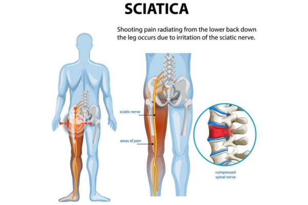 Dr. Deepak Aiwale Neurologist in Thane – Advanced Treatment for Sciatica or Lumbar Canal Stenosis