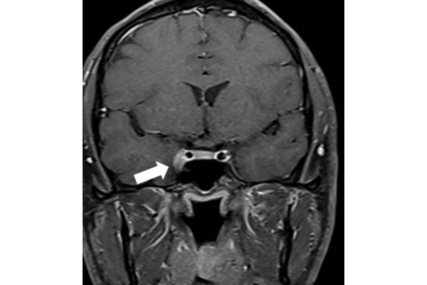 Tolosa Hunt Syndrome: Accurate Diagnosis and Effective Treatment