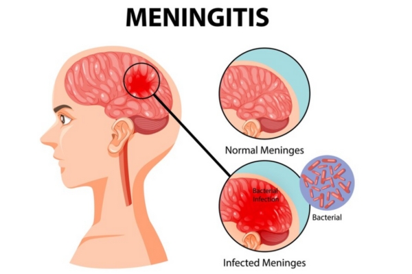 Meningitis Treatment: Early Diagnosis Saves Lives