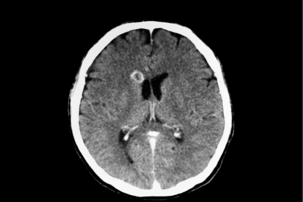 Best treatment for Cortical Venous Sinus Thrombosis: Symptoms and Treatments