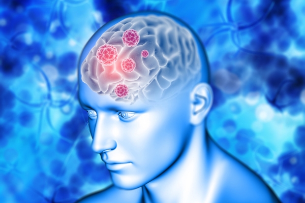 Best Neurologist in Thane for Comprehensive Brain Tumor Care
