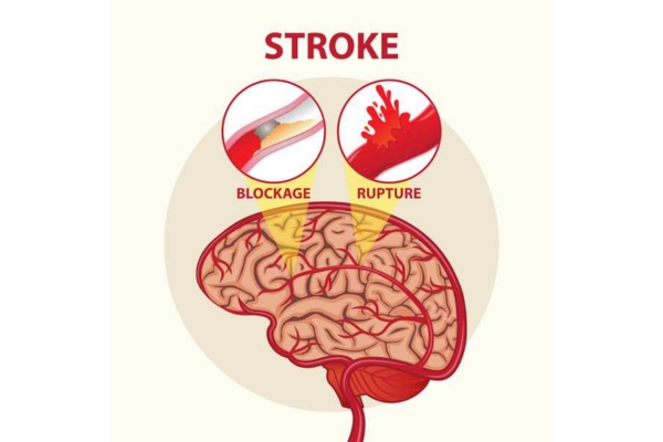 Best Stroke Specialist in Thane: Timely Care for Better Outcomes