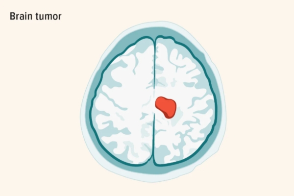Best Brain Tumor Specialist in Thane - Dr. Deepak Aiwale The Best Brain Tumor Treatment Near Me