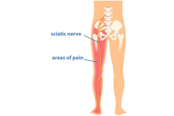 Best Sciatica Treatment in Thane for Lasting Relief