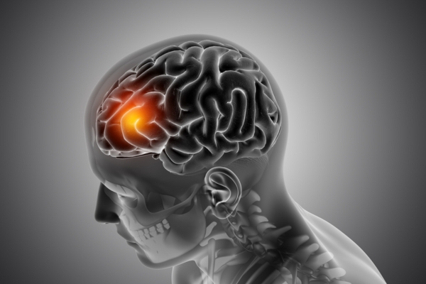 Best Brain Tumor Specialist in Thane – Timely Detection, Effective Treatment