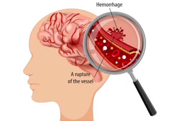 Best Doctor for Brain Haemorrhage in Thane – Emergency and Recovery Care